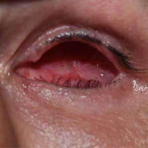 Enucleation, Evisceration & Exenteration1